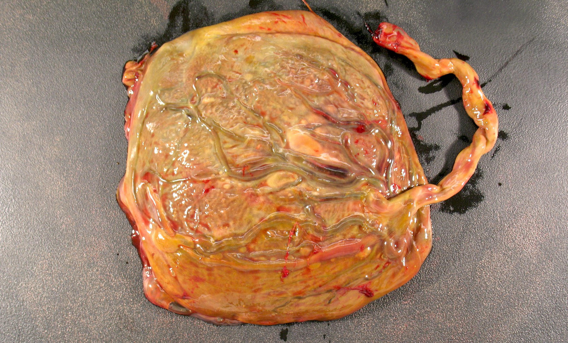 Umbilical cord and fetal surface discoloration