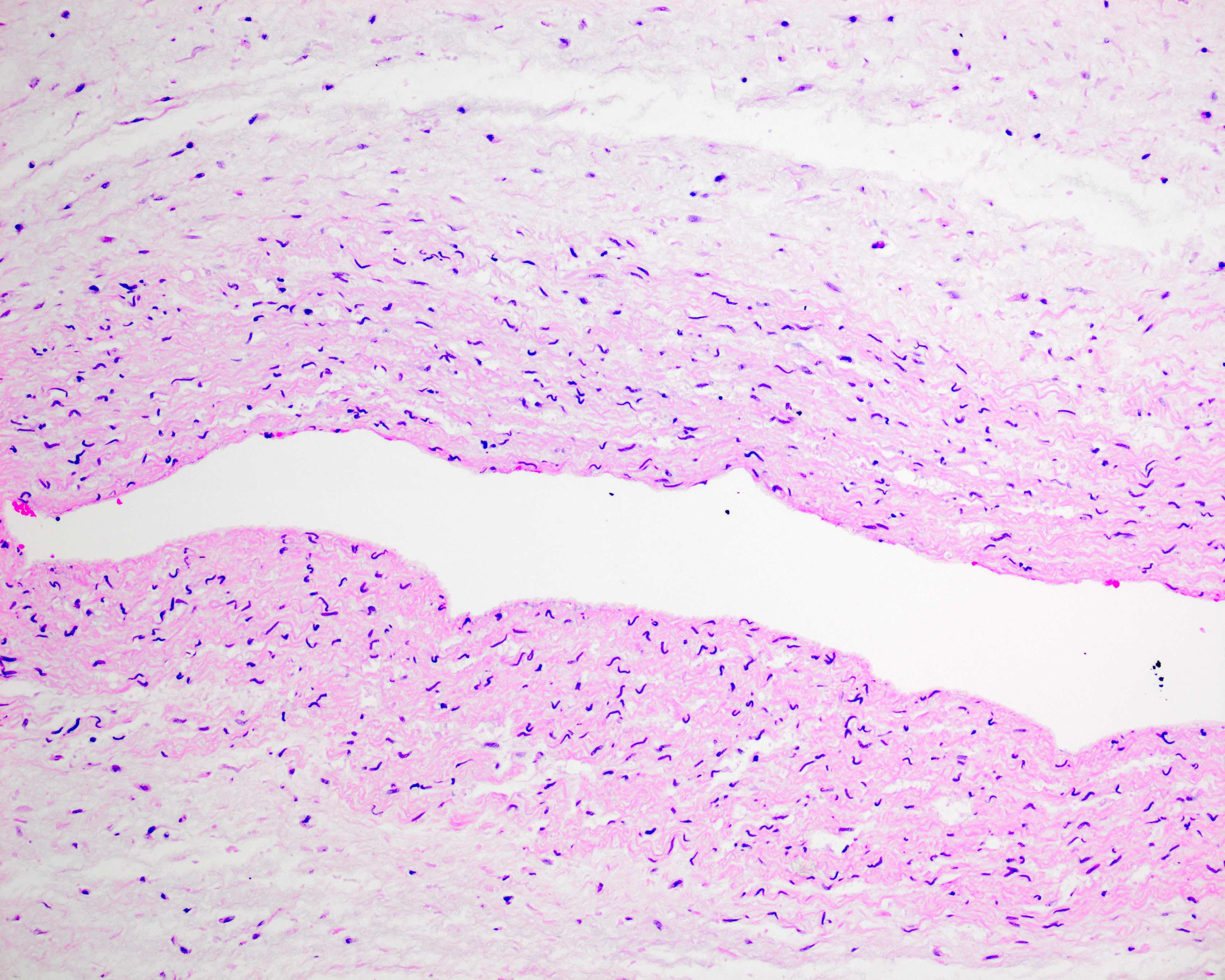 Ischemic umbilical myocyte elongation