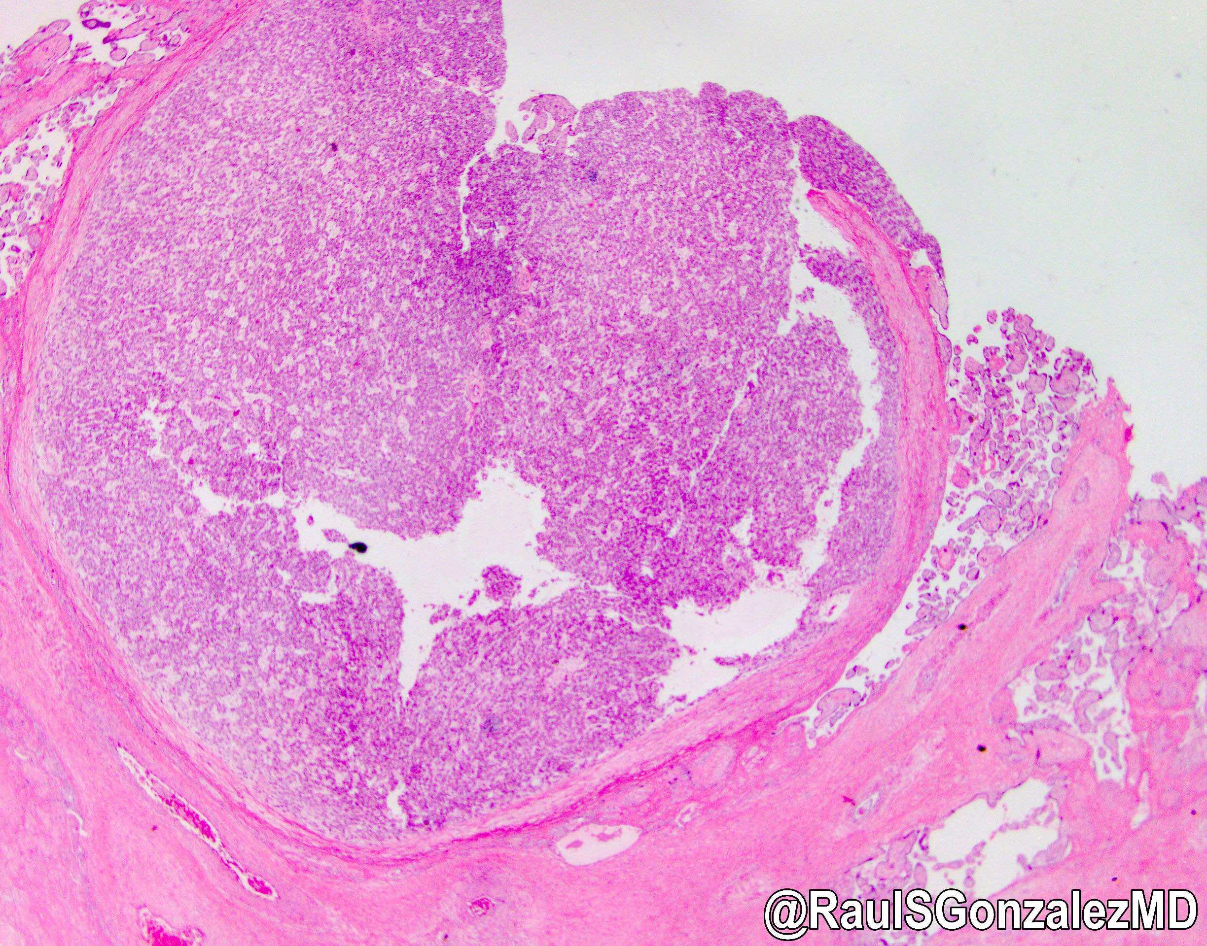 Hepatocellular adenoma-like lesion of placenta