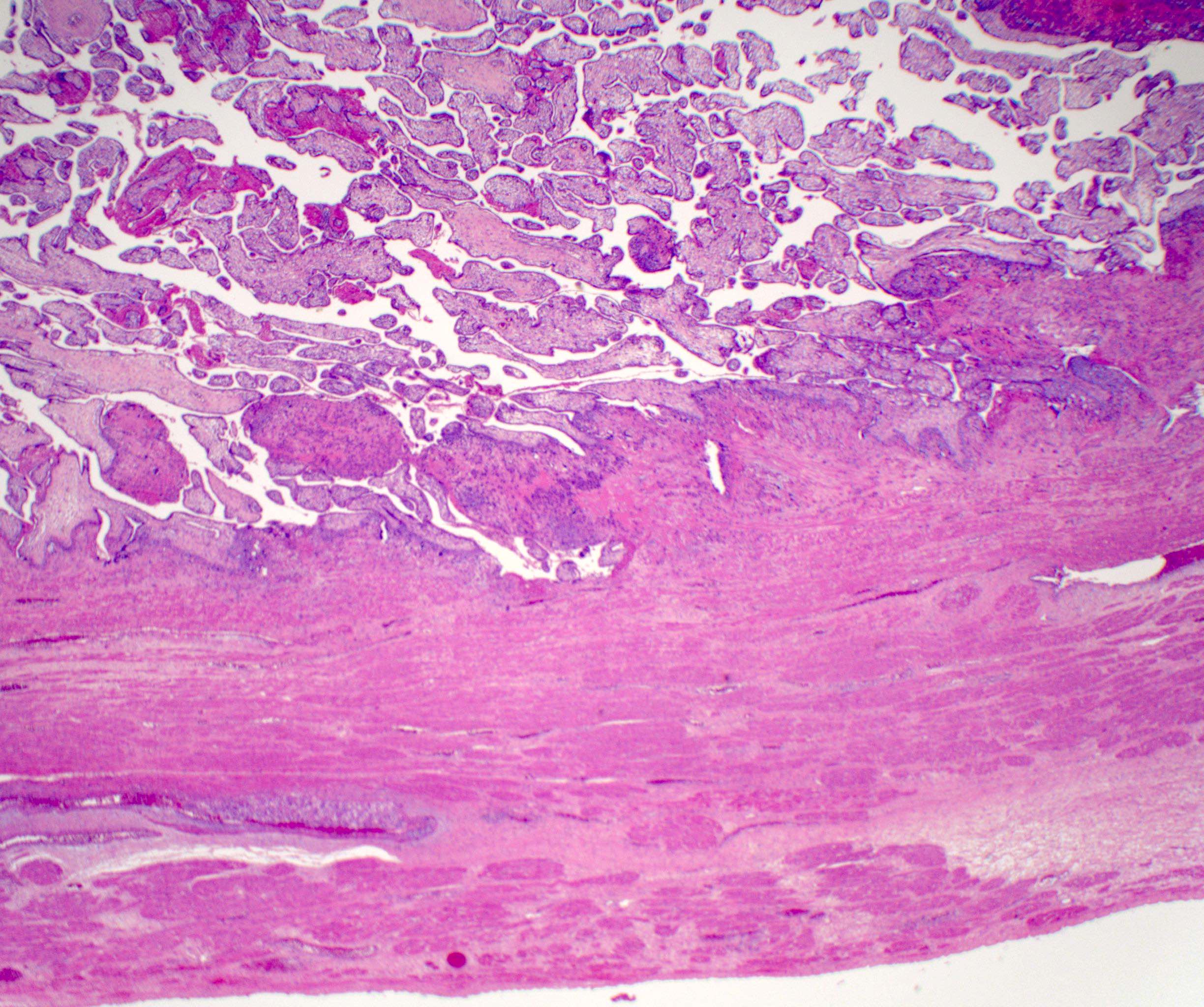pathology of the placenta