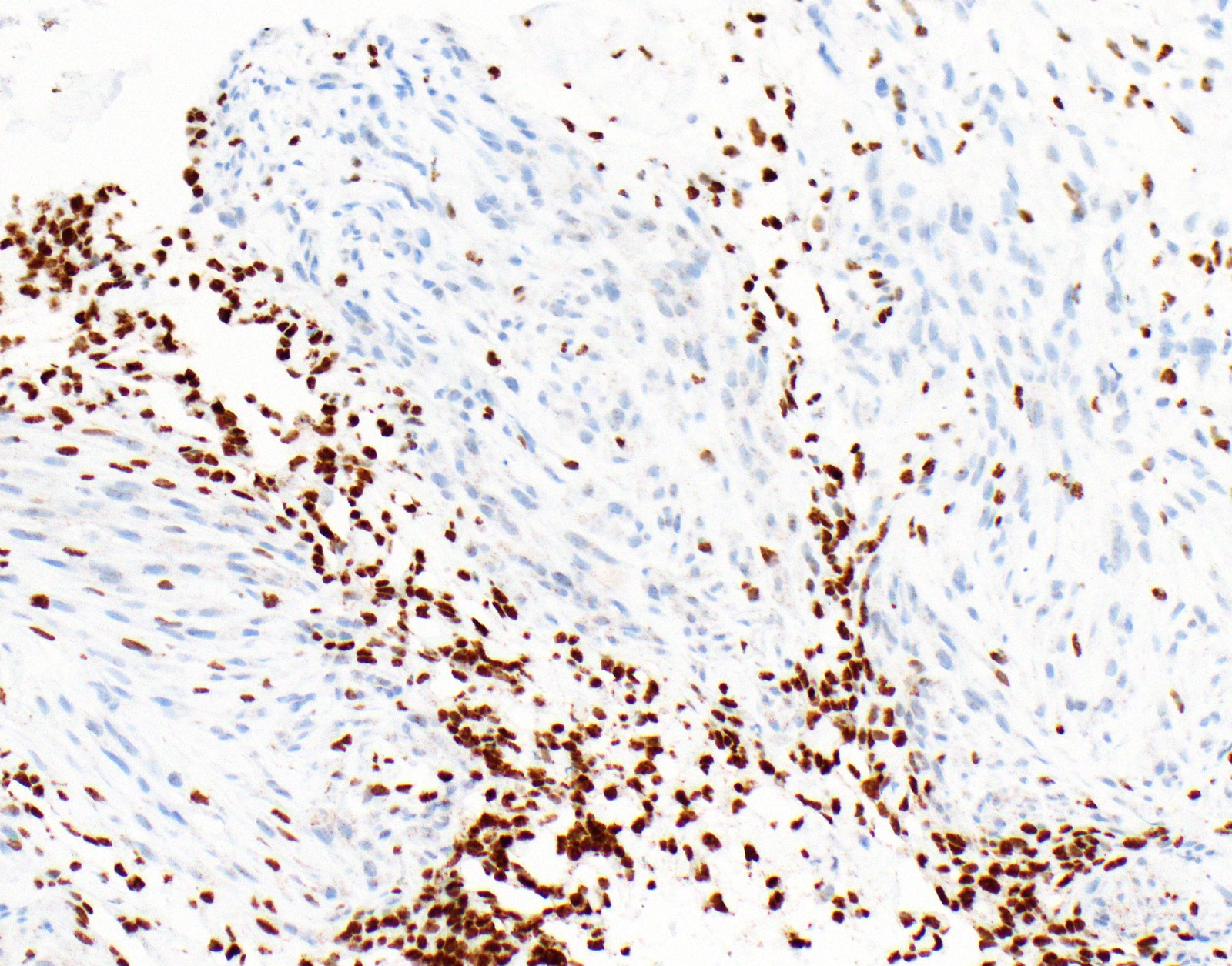 spindle cell mesothelioma pathology outlines