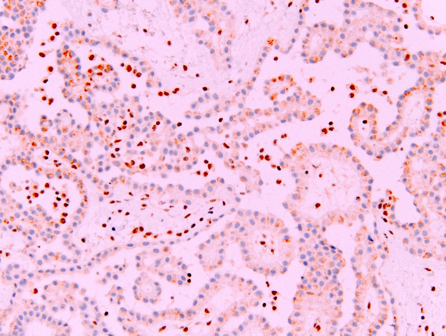 Epithelioid mesothelioma with papillary features
