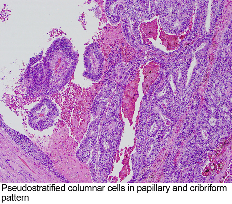prostatic ductal adenocarcinoma pathology outlines A krónikus prosztatitis következményei a férfiakban
