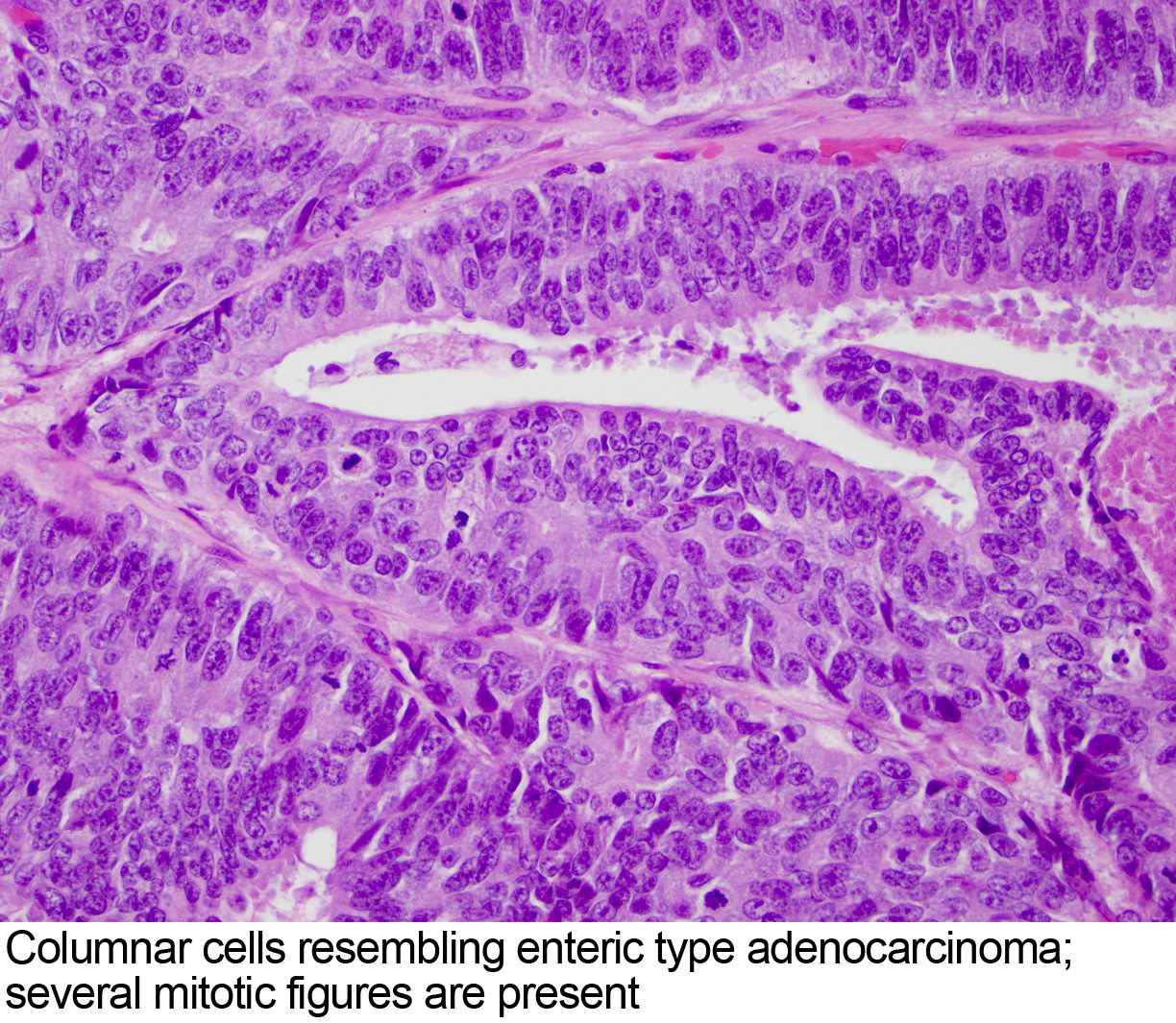 prostatic adenocarcinoma ihc pathology outlines
