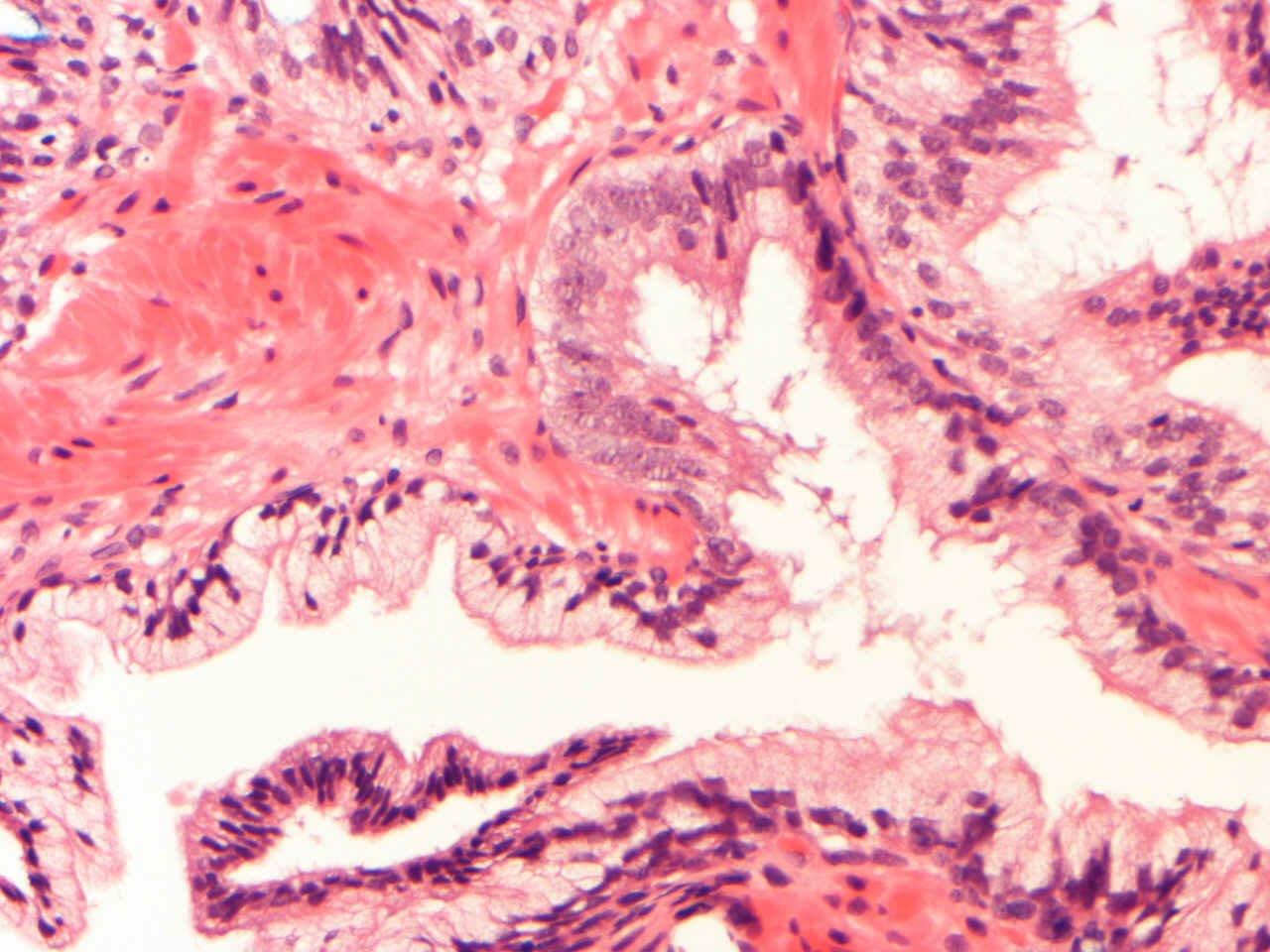 prostatic intraepithelial neoplasia pin pathology outlines Mi a fibrózis a prosztatában