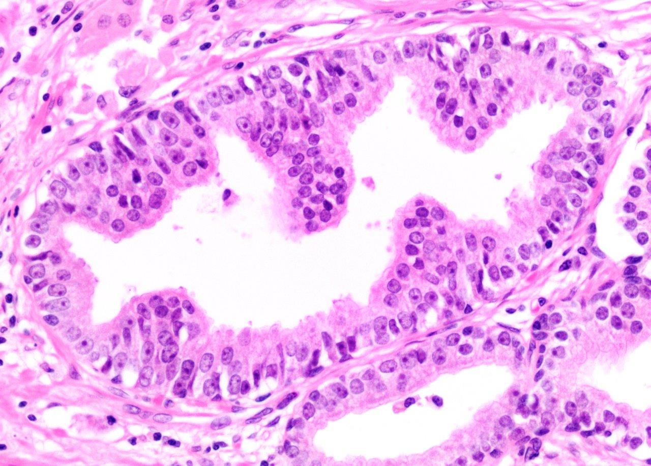 Pancreatic cancer pathology outlines