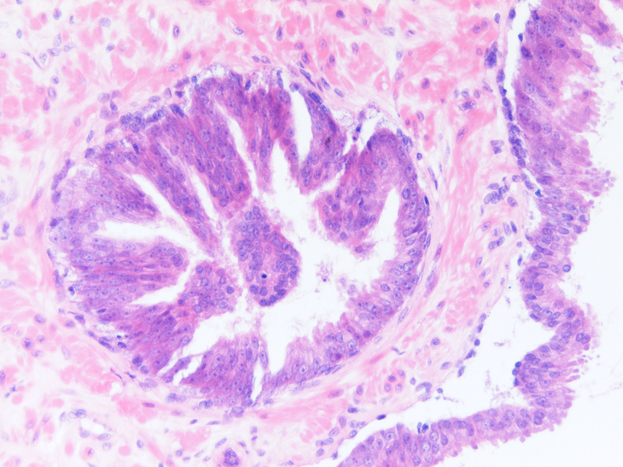 prostatic intraepithelial neoplasia pin pathology outlines aloe a mézzel a prosztatitishez