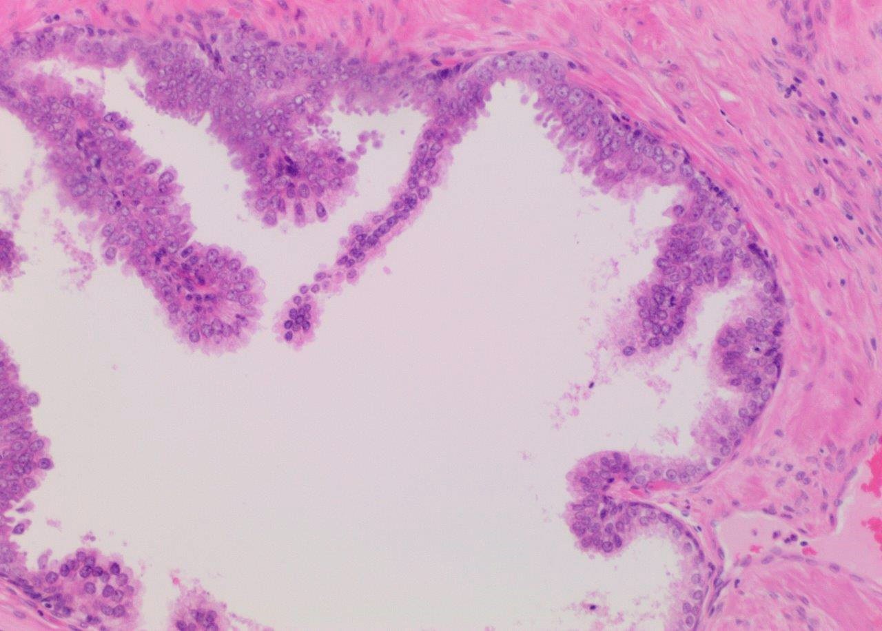 pin prostate pathology outlines
