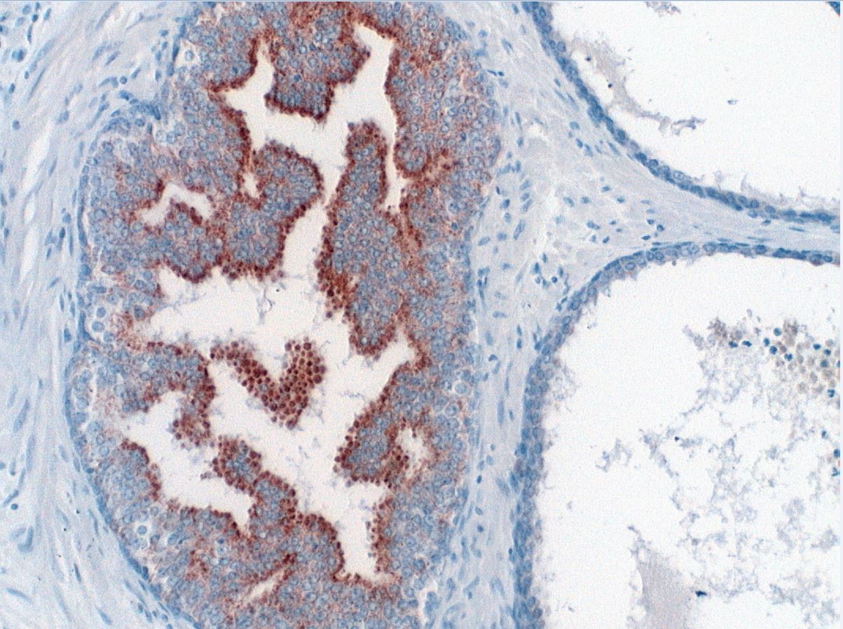 pin prostate pathology outlines este posibil să se vindece prostatita acasă