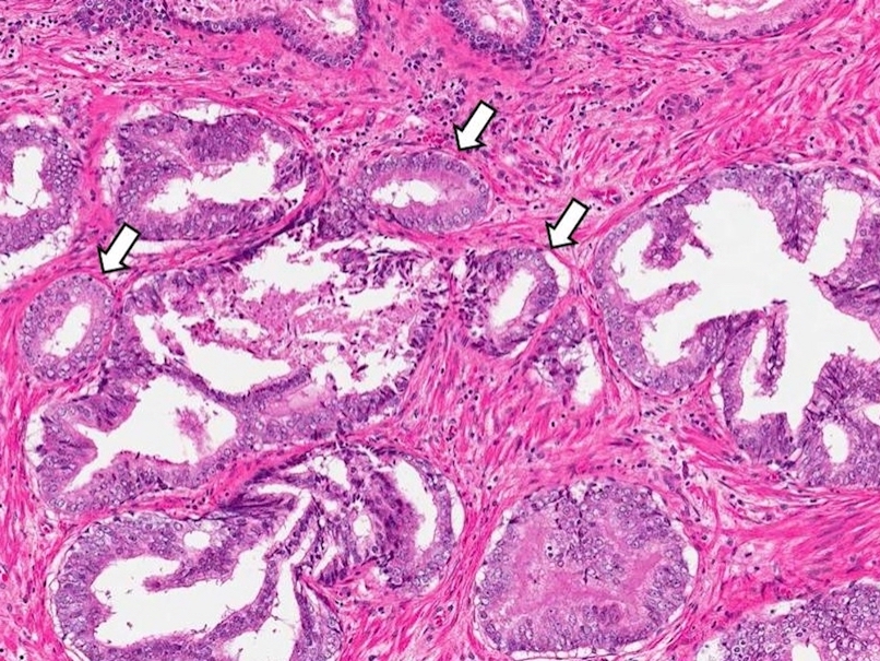 pin prostate pathology outlines
