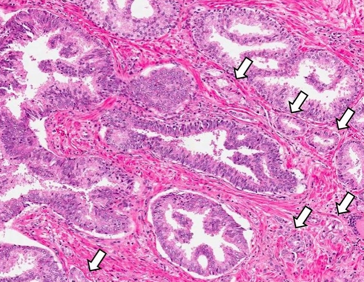 prostate pin pathology outlines