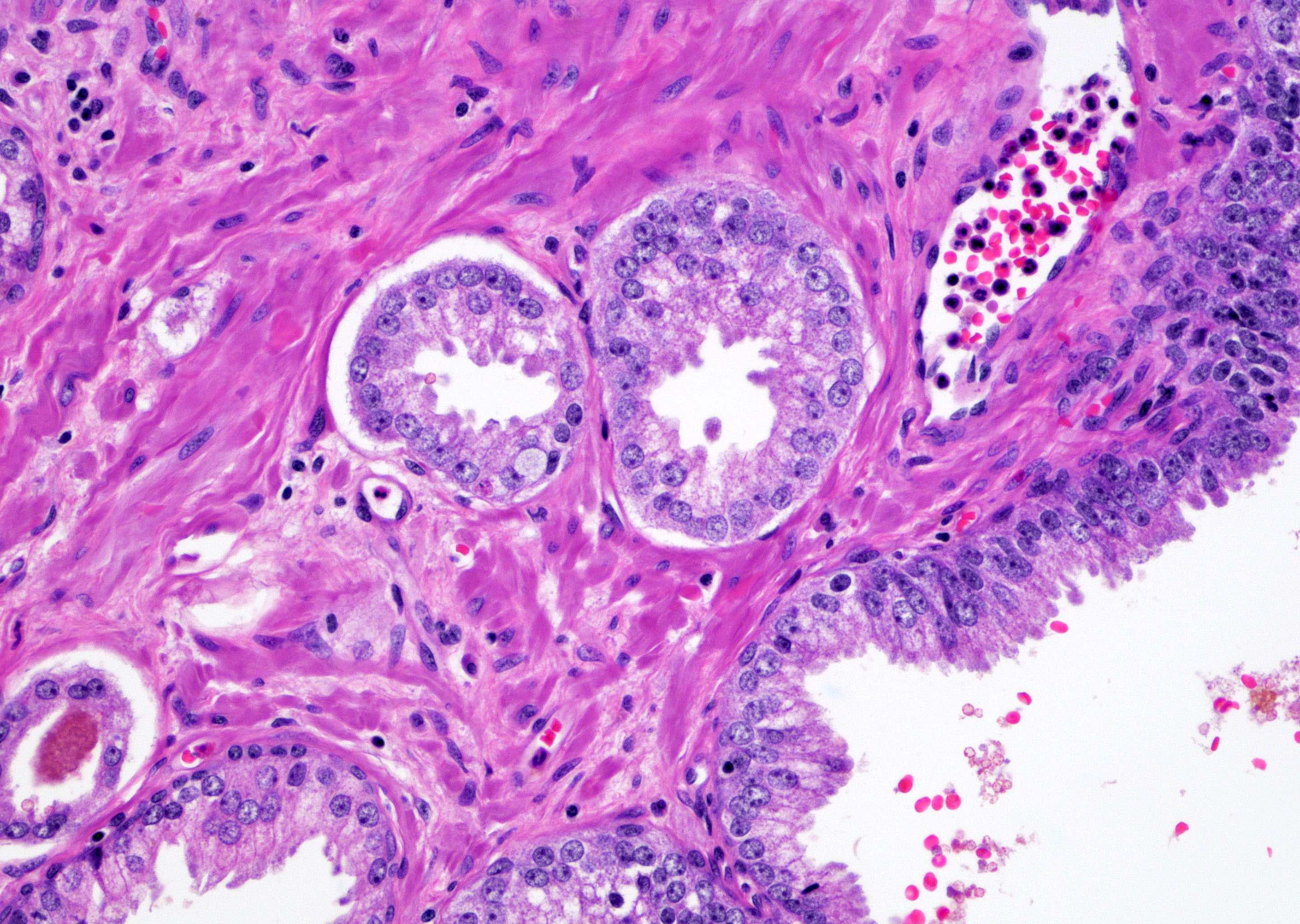 Atypical gland with basal cells