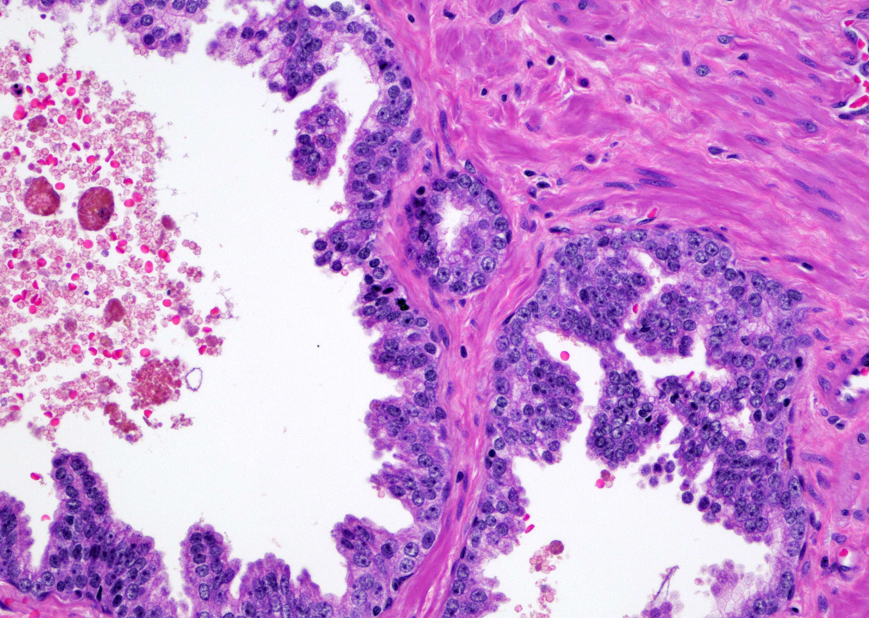 Atypical gland in 2 HGPINs