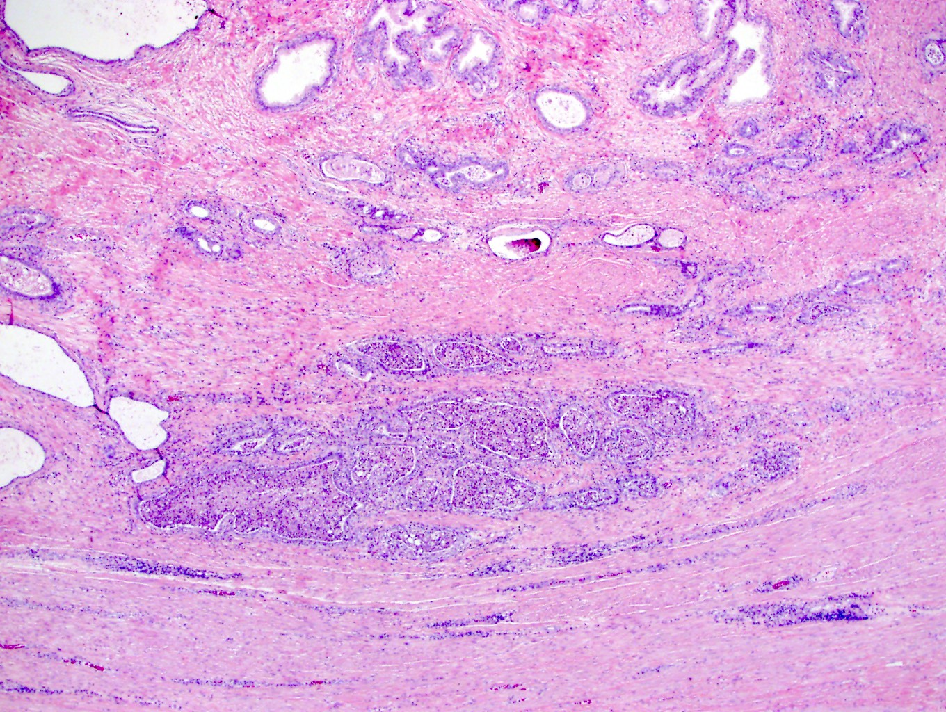 Prostatic microabscess