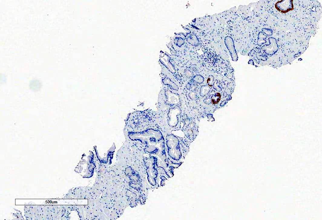 Pseudohyperplastic variant of prostate cancer