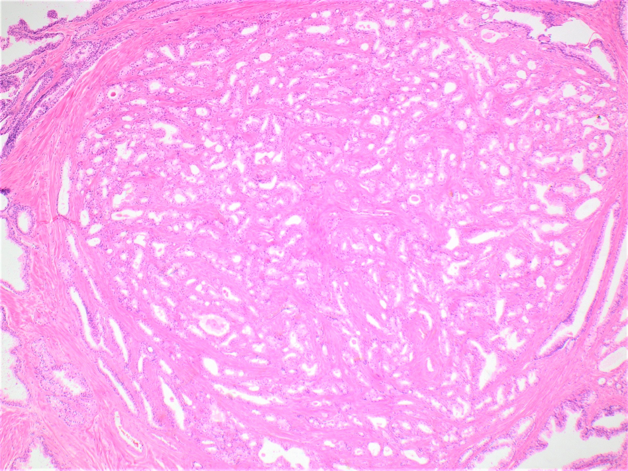 benign adenomyomatous hyperplasia of prostate icd 10