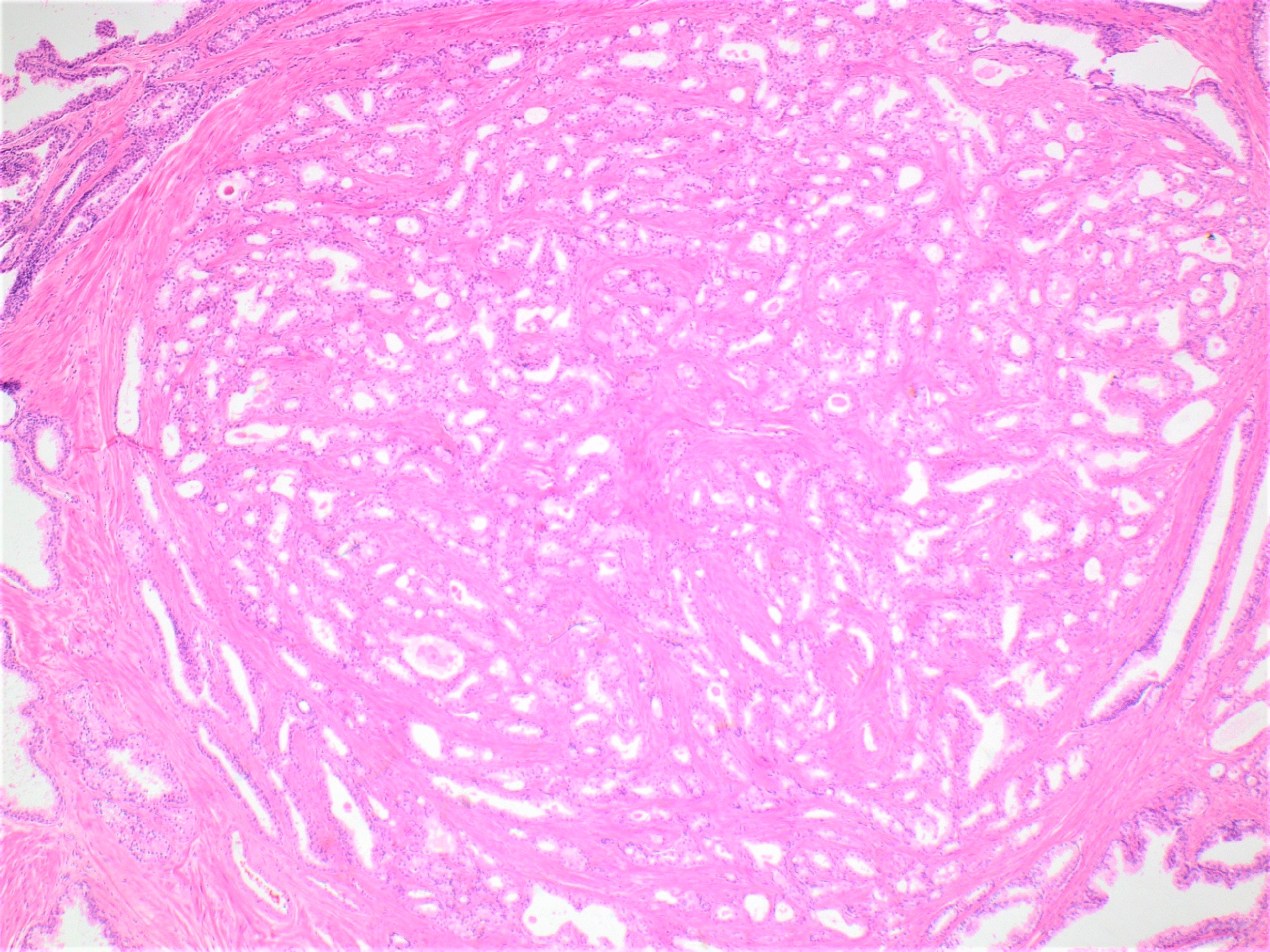 prostatic adenoma pathology outlines