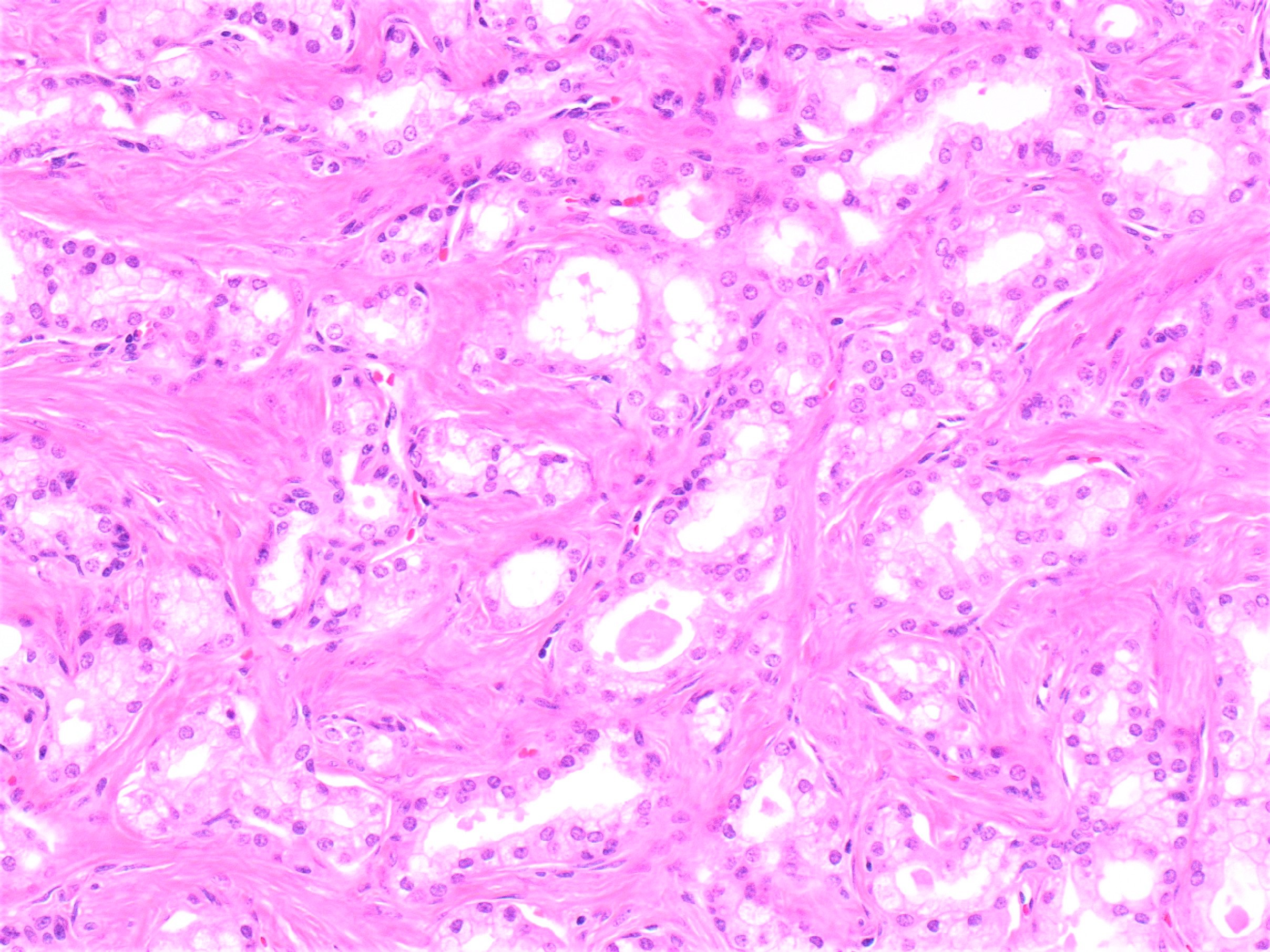 Papillary urothelial carcinoma of the bladder icd 10 - Papillary urothelial cancer icd 10
