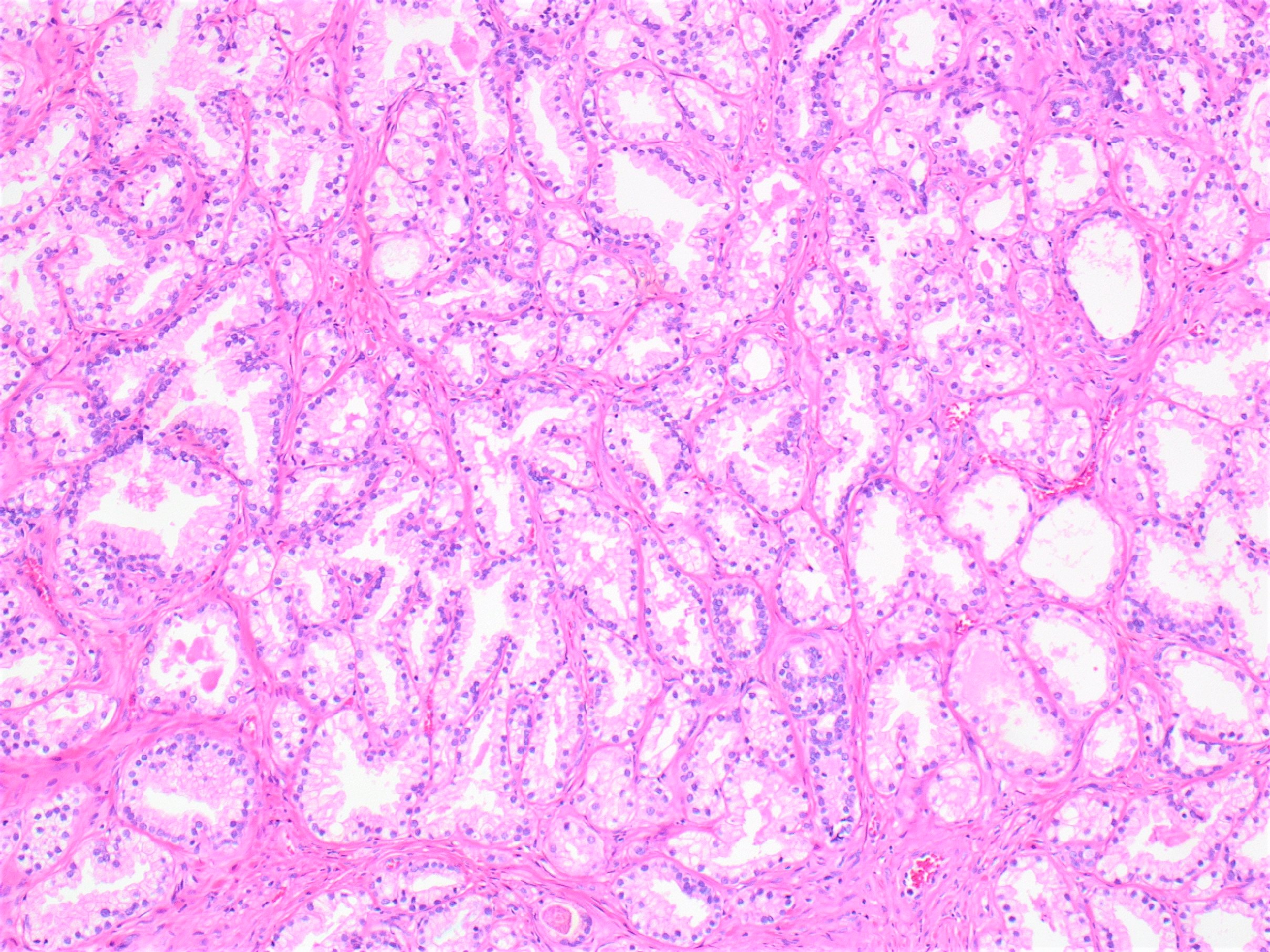 prostatic adenocarcinoma ihc pathology outlines)