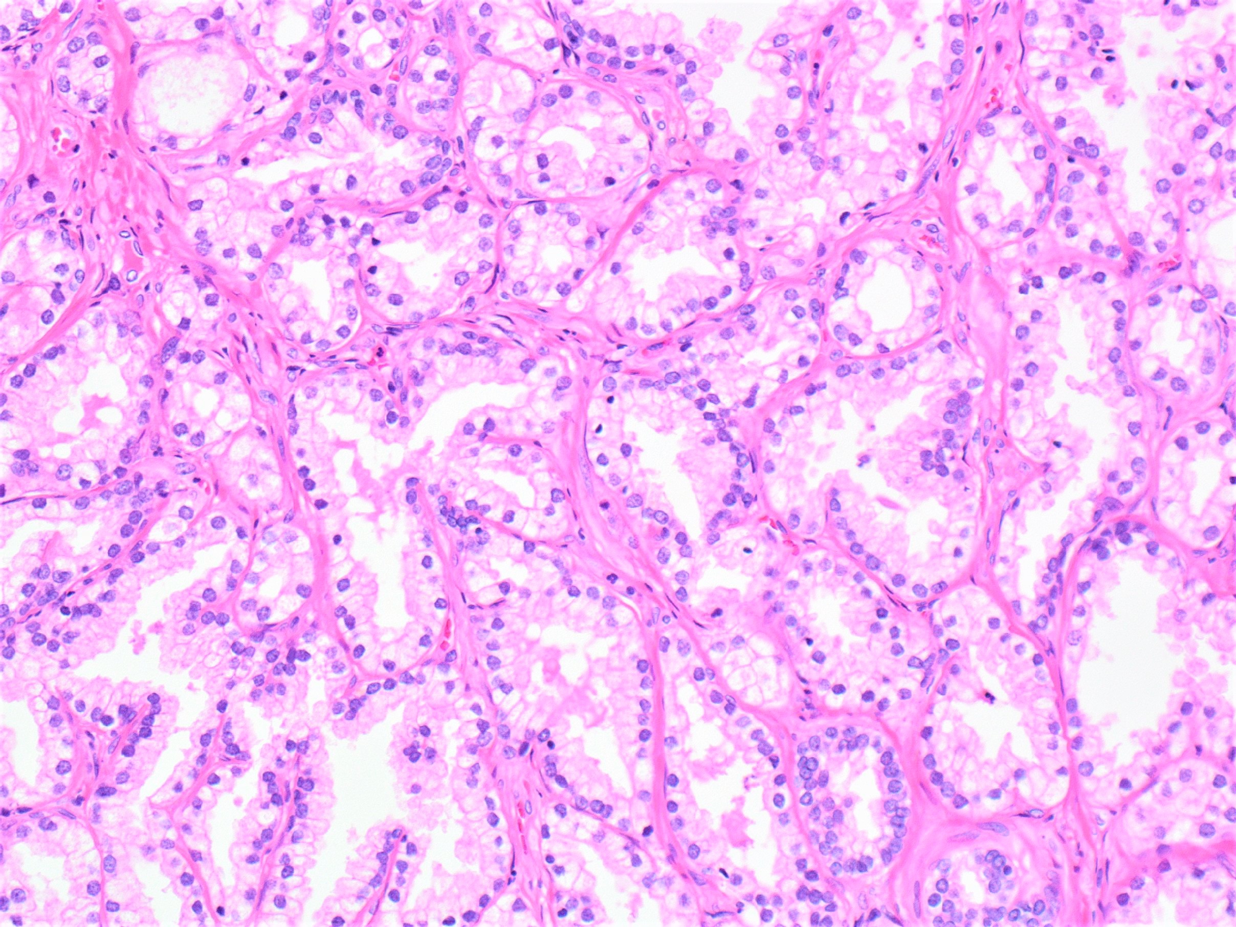 Papillary urothelial hyperplasia bladder