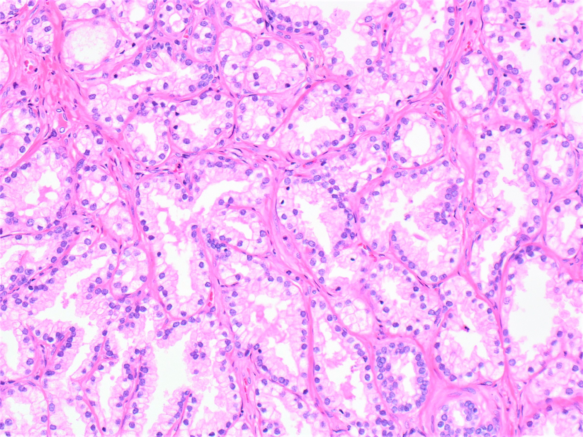 prostate atrophy pathology outlines