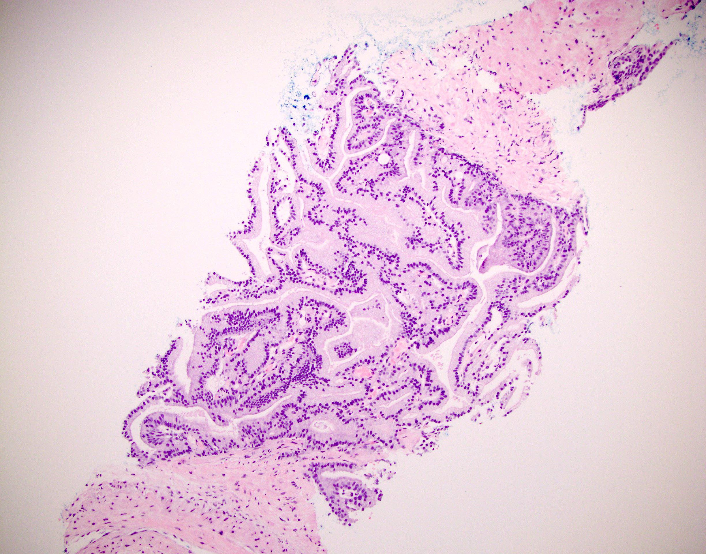 Isolated AIP on biopsy