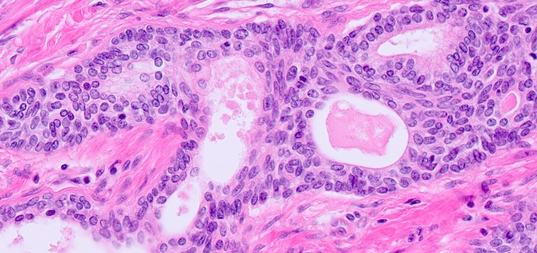 basal cell hyperplasia prostate pathology outlines)