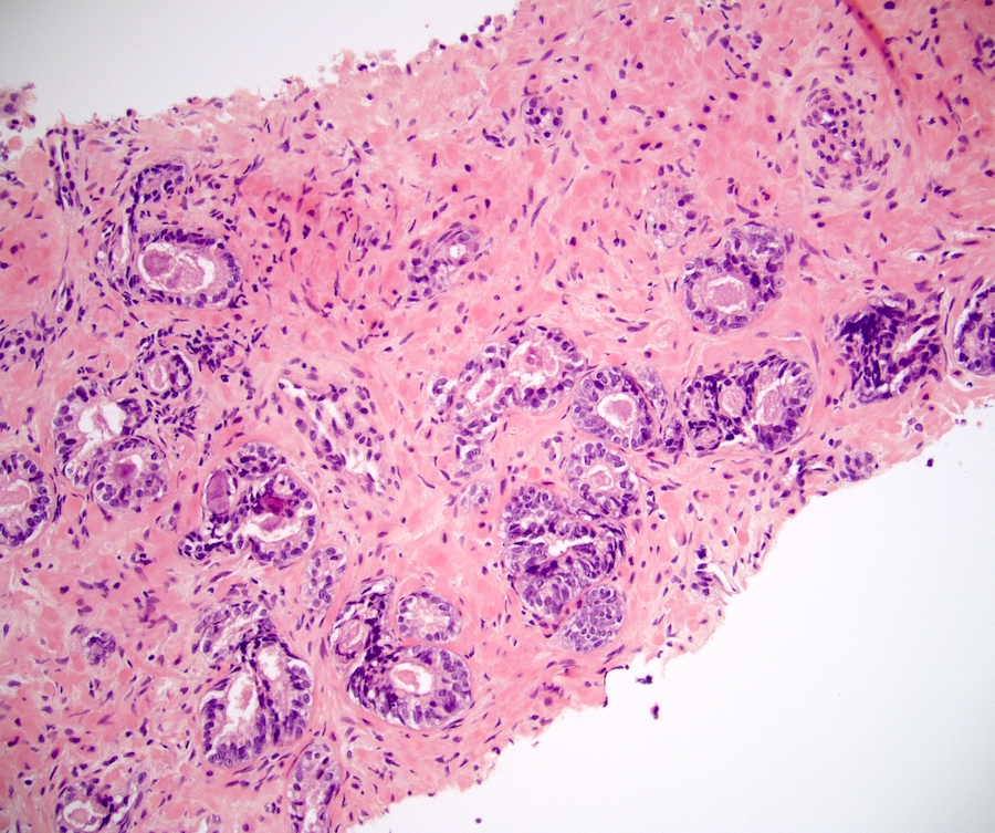 Papillary urothelial hyperplasia bladder