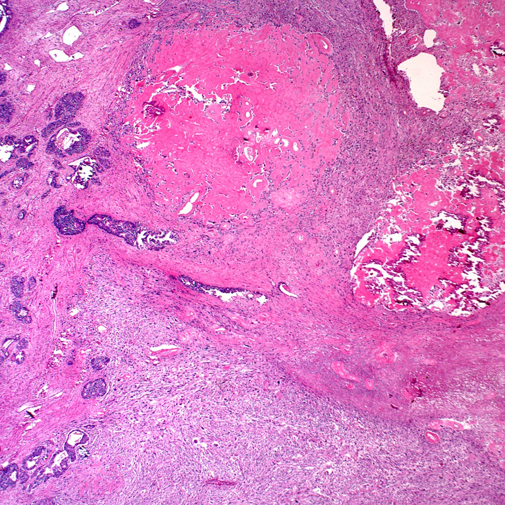 Heterologous osteosarcoma pattern