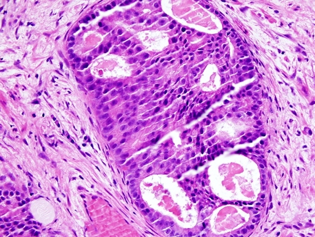 prostate core biopsy pathology outlines)