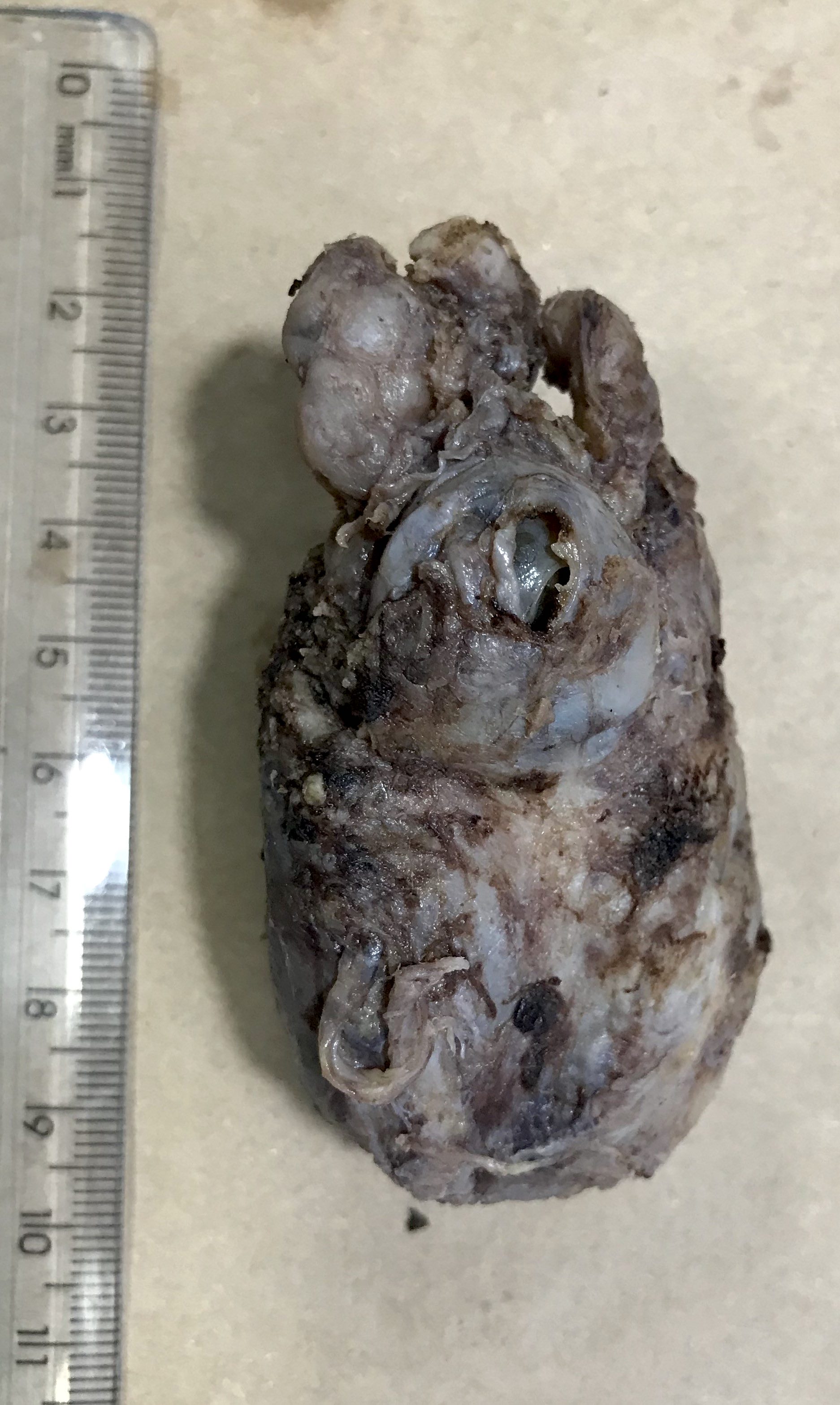 Cystic mass centered in the seminal vesicle