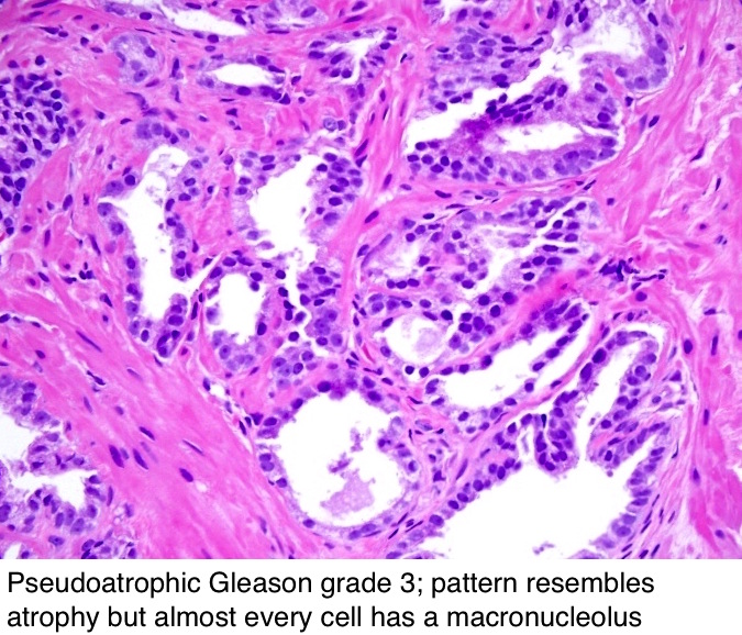prostate adenocarcinoma gleason score pathology outlines)