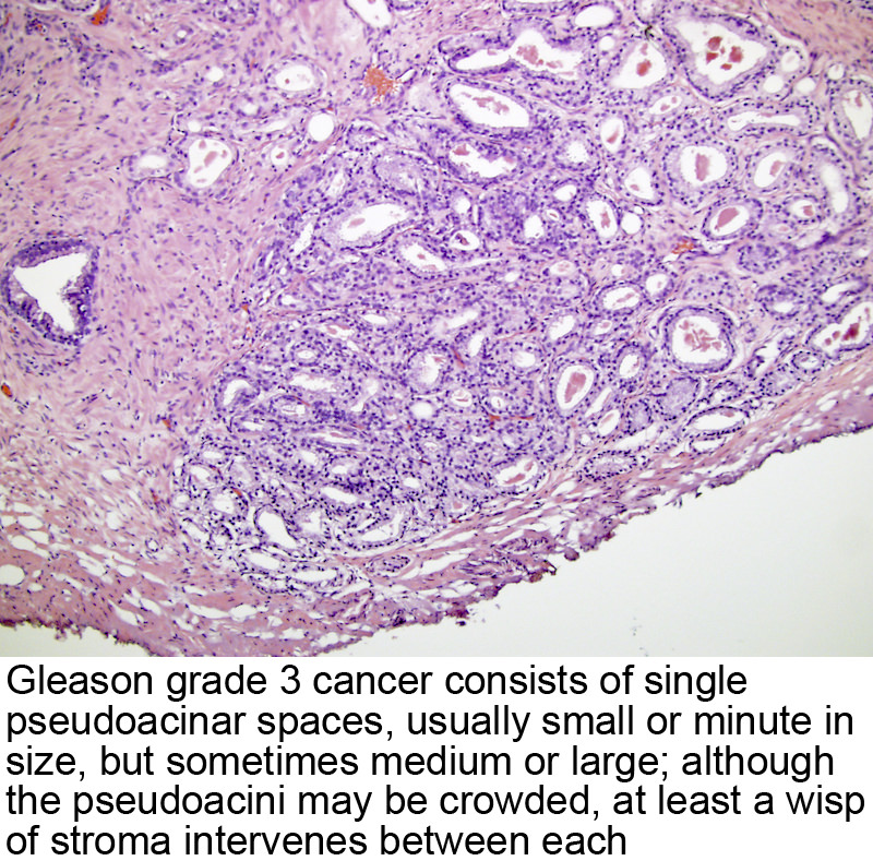 histology of prostatic adenocarcinoma A krónikus prosztatitis hiányos elengedése