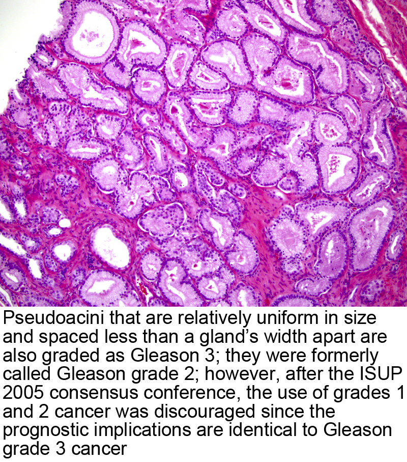 prostate core biopsy pathology outlines