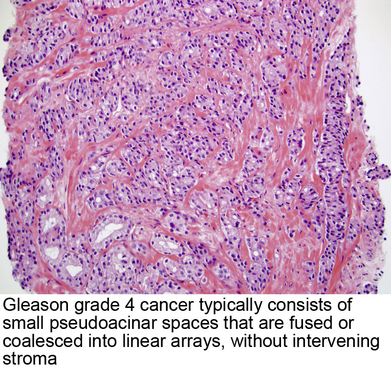 adenocarcinoma prostate acinar score gleason 8)