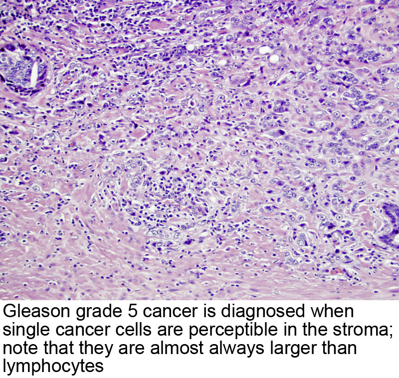 acinar adenocarcinoma prostate gleason score