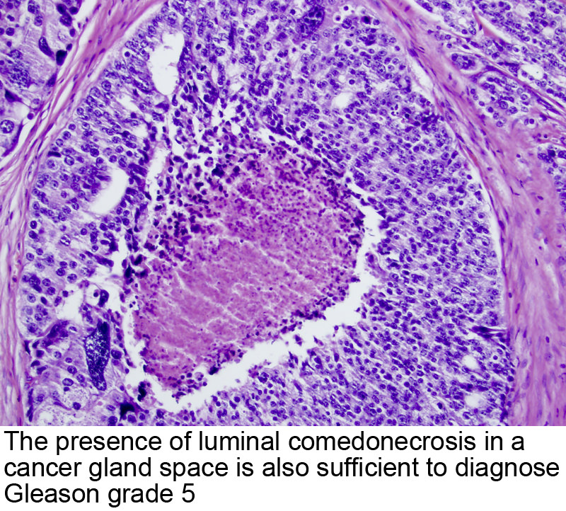 prostate core biopsy pathology outlines