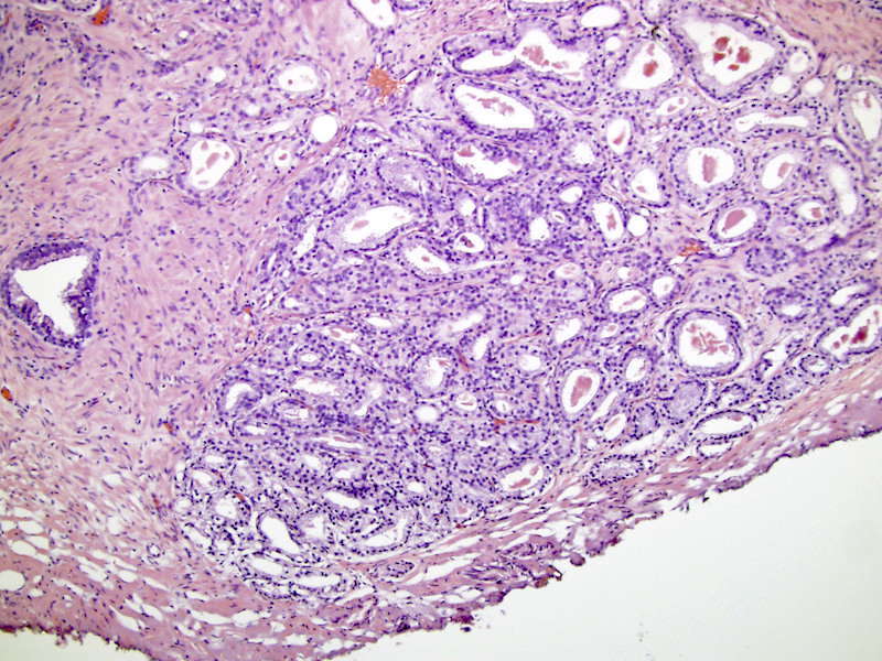 ductal adenocarcinoma prostate pathology outlines)