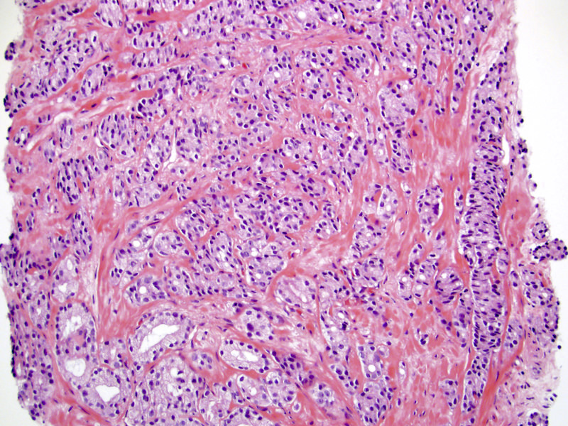 prostate adenocarcinoma gleason score pathology outlines