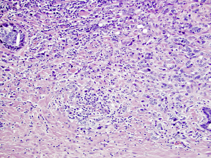 Fișier:Prostate cancer with Gleason pattern 4 low mag.jpg