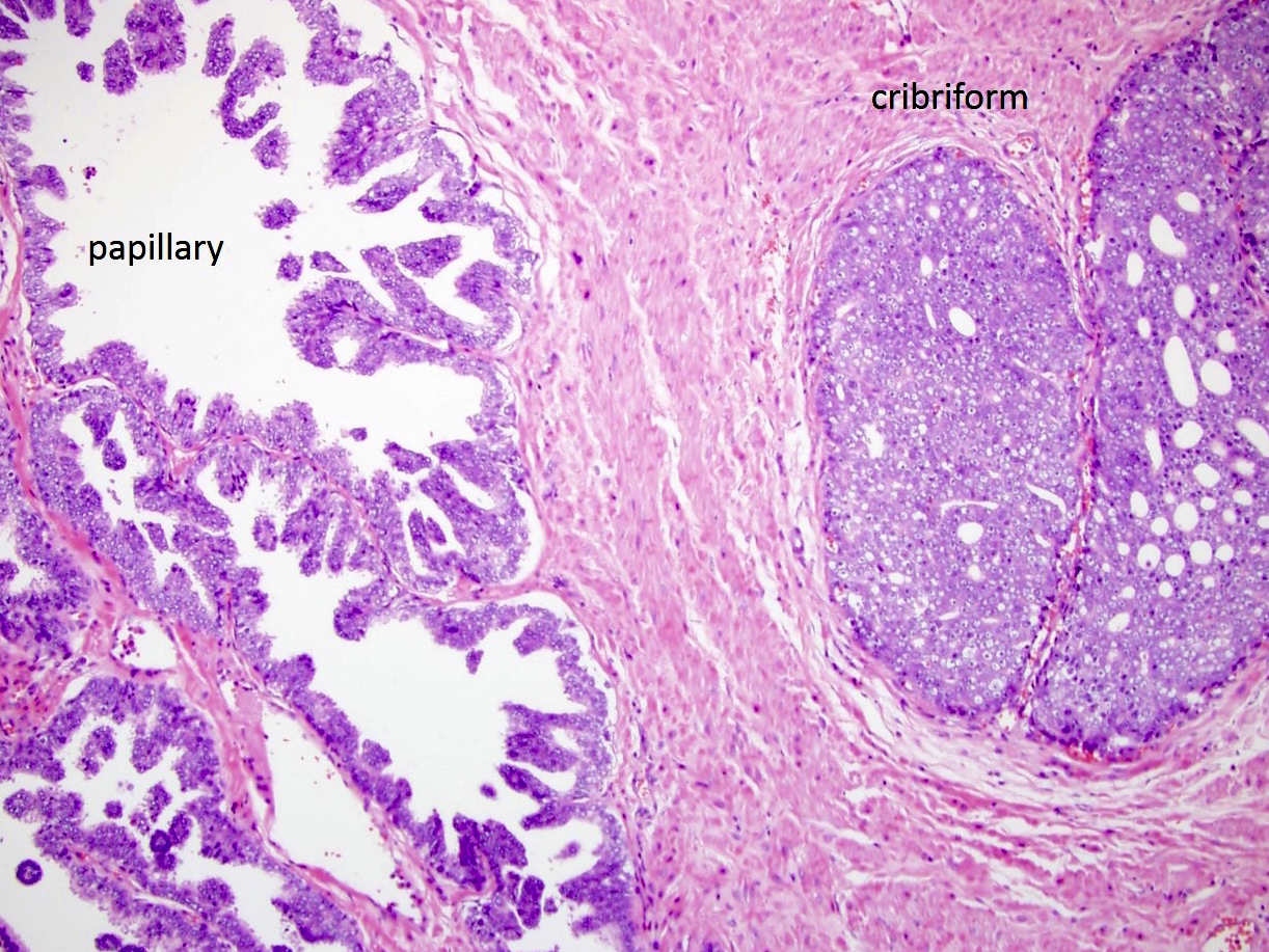 pin like ductal adenocarcinoma prostate pathology outlines)