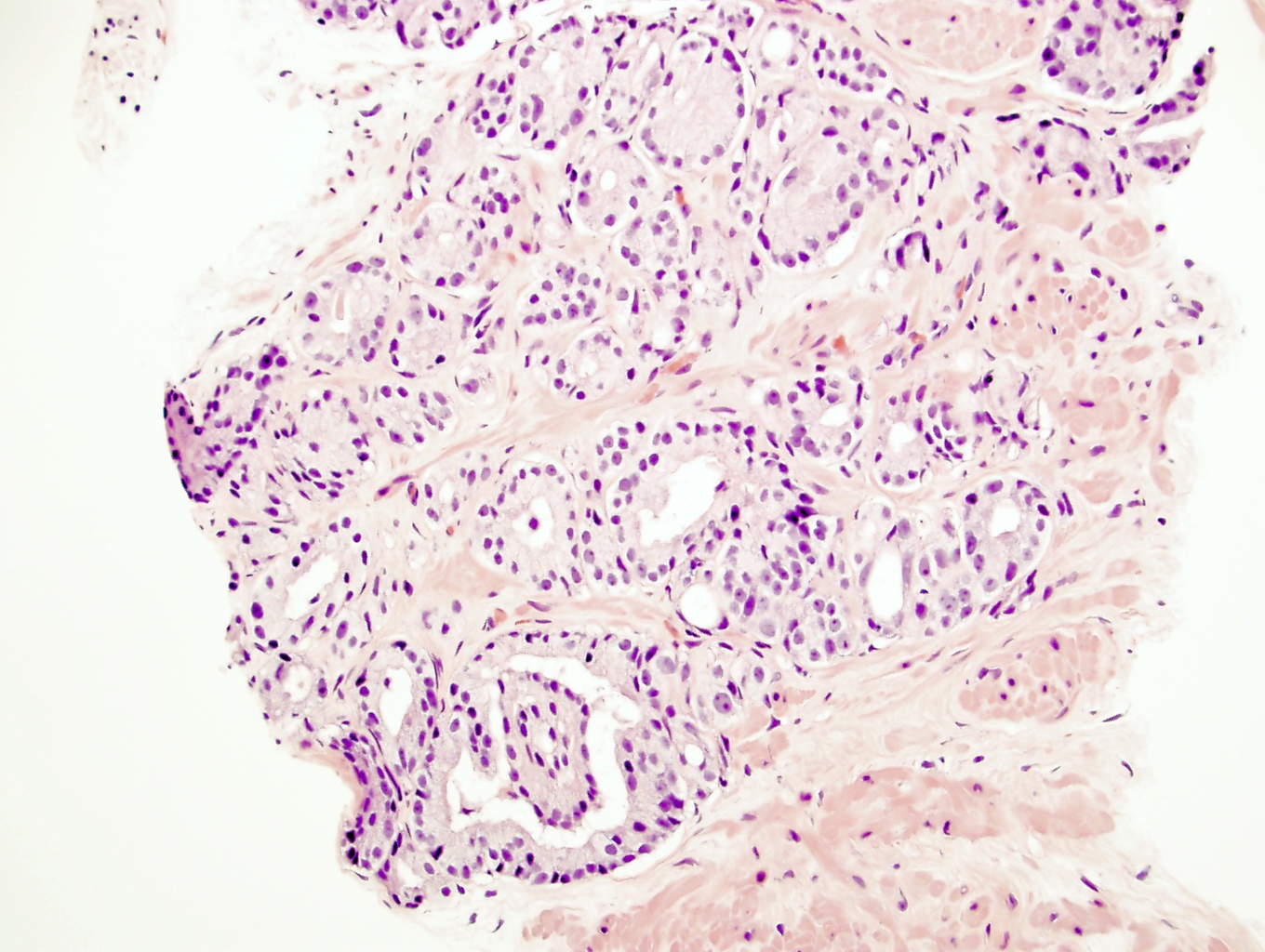 prostate adenocarcinoma gleason score pathology outlines