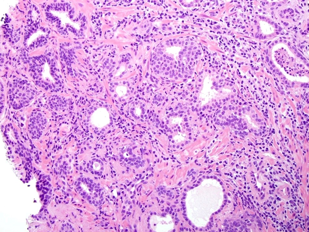 Prostate adenocarcinoma acinar type