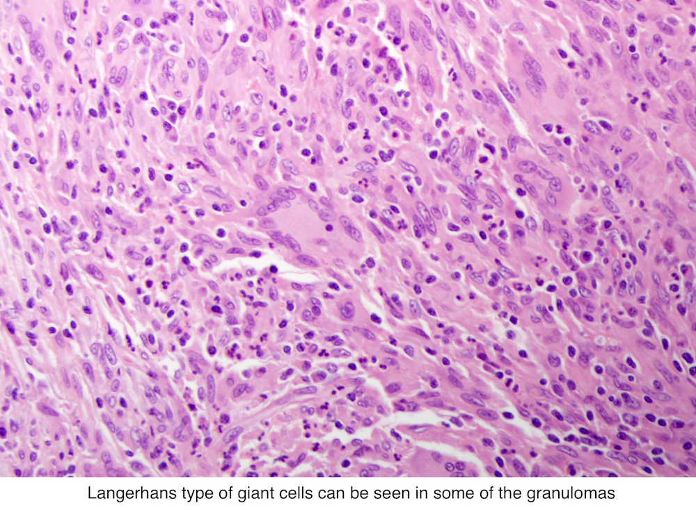 Prosztatarák – Gleason Pontszám 9 Prostatic adenoma pathology outlines