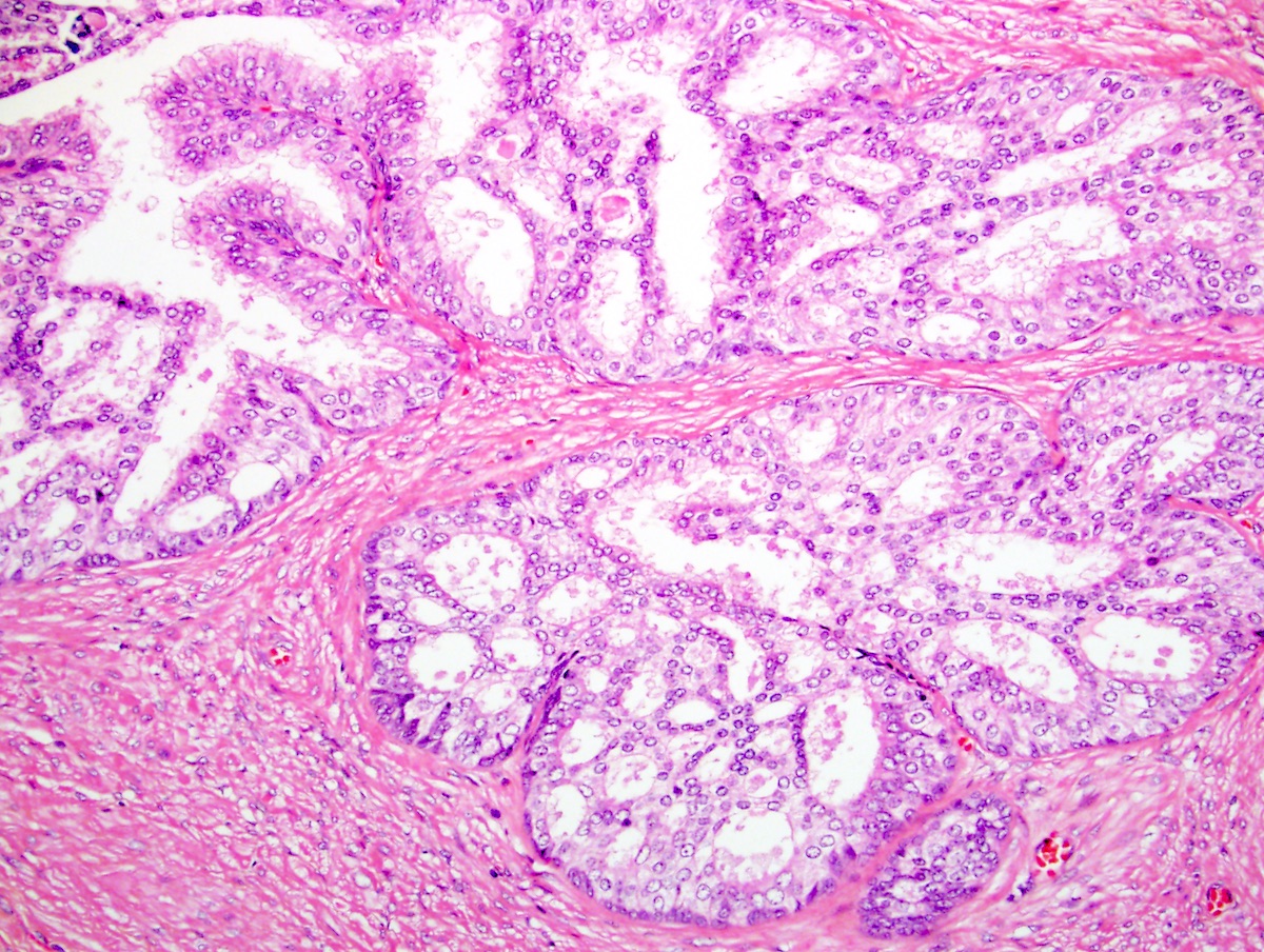 Clinical trials Histology of prostate adenocarcinoma