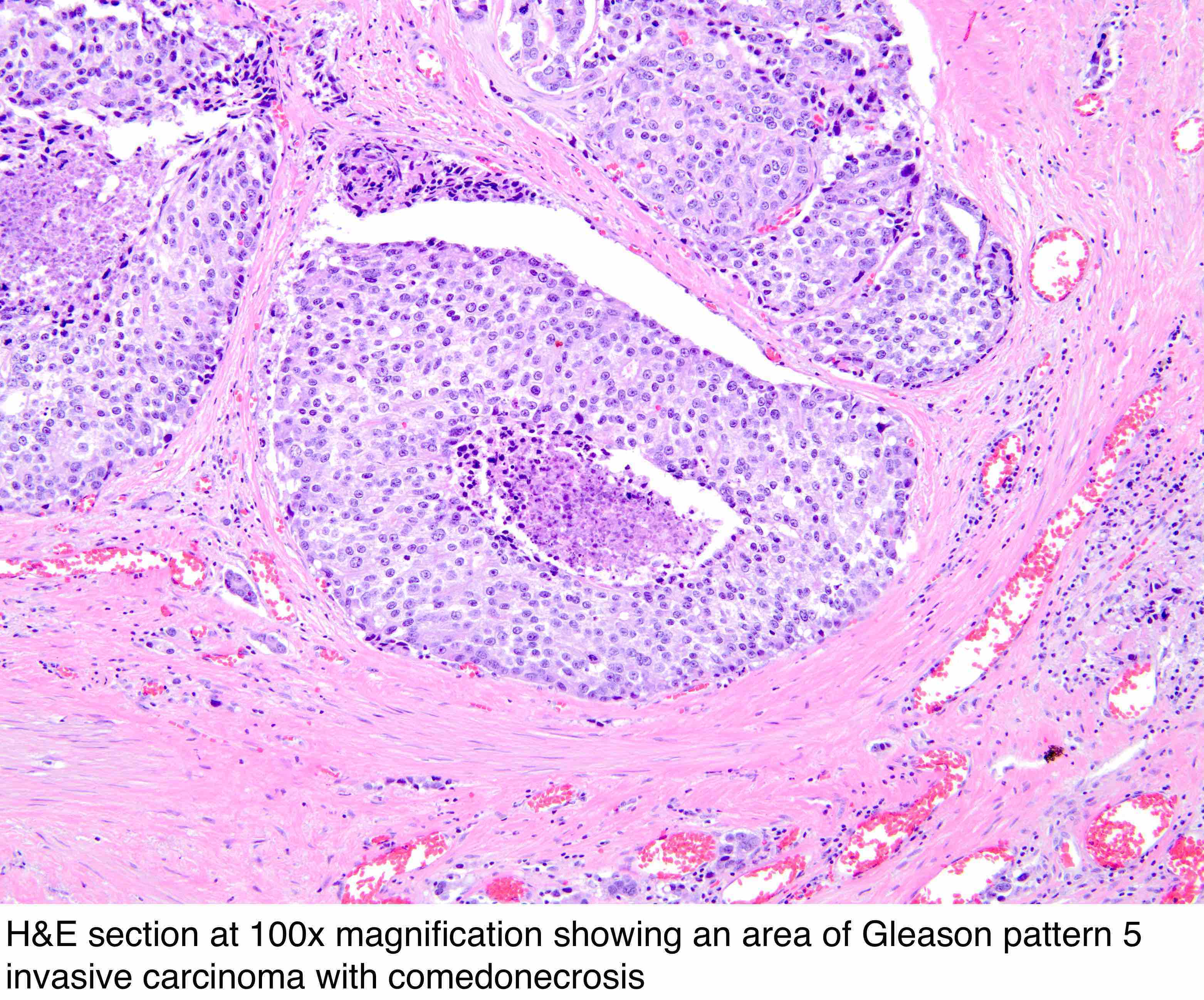 prostate intraductal adenocarcinoma pathology outlines A prosztata italt Kvass