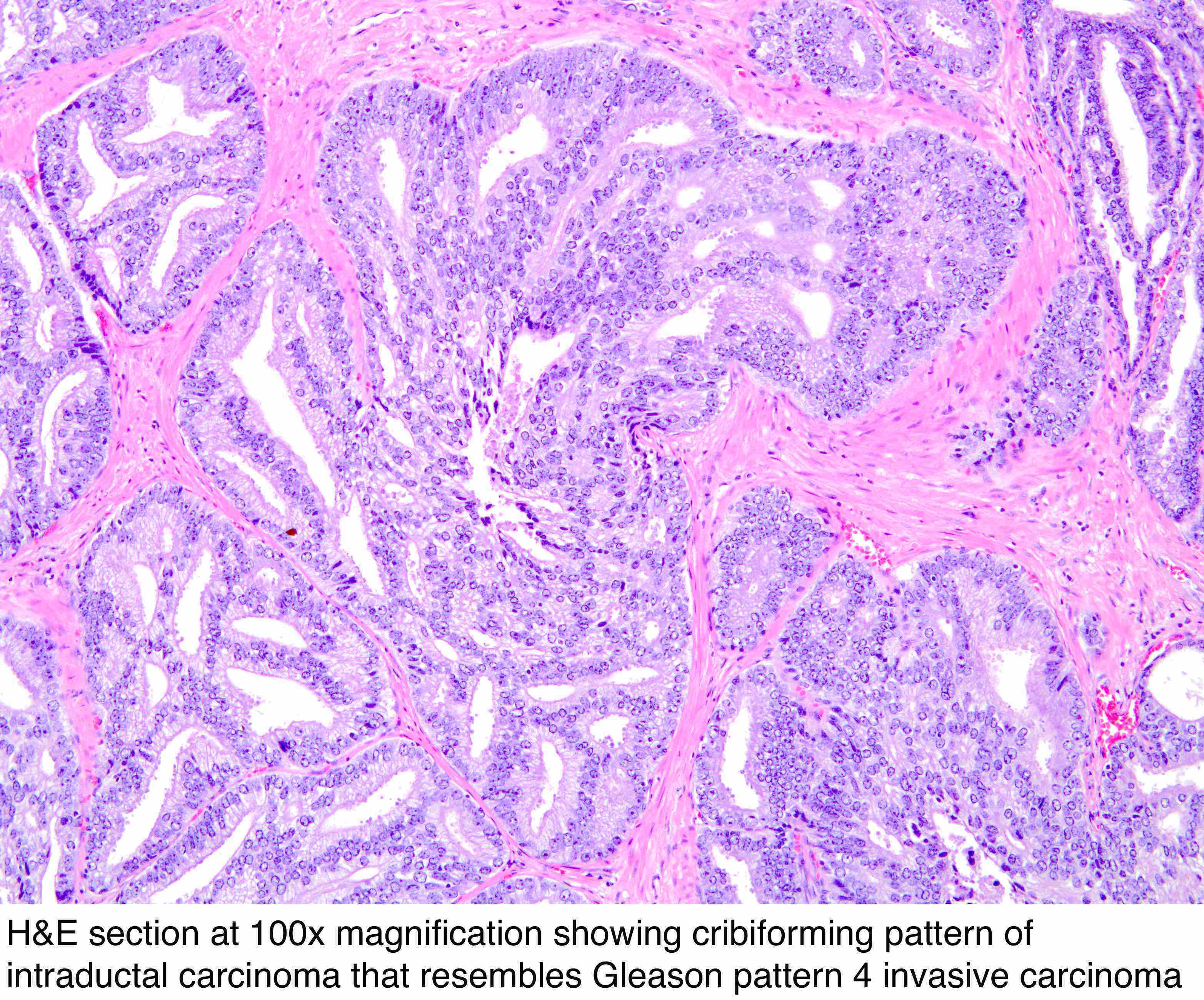 urothelial carcinoma prostate pathology outlines