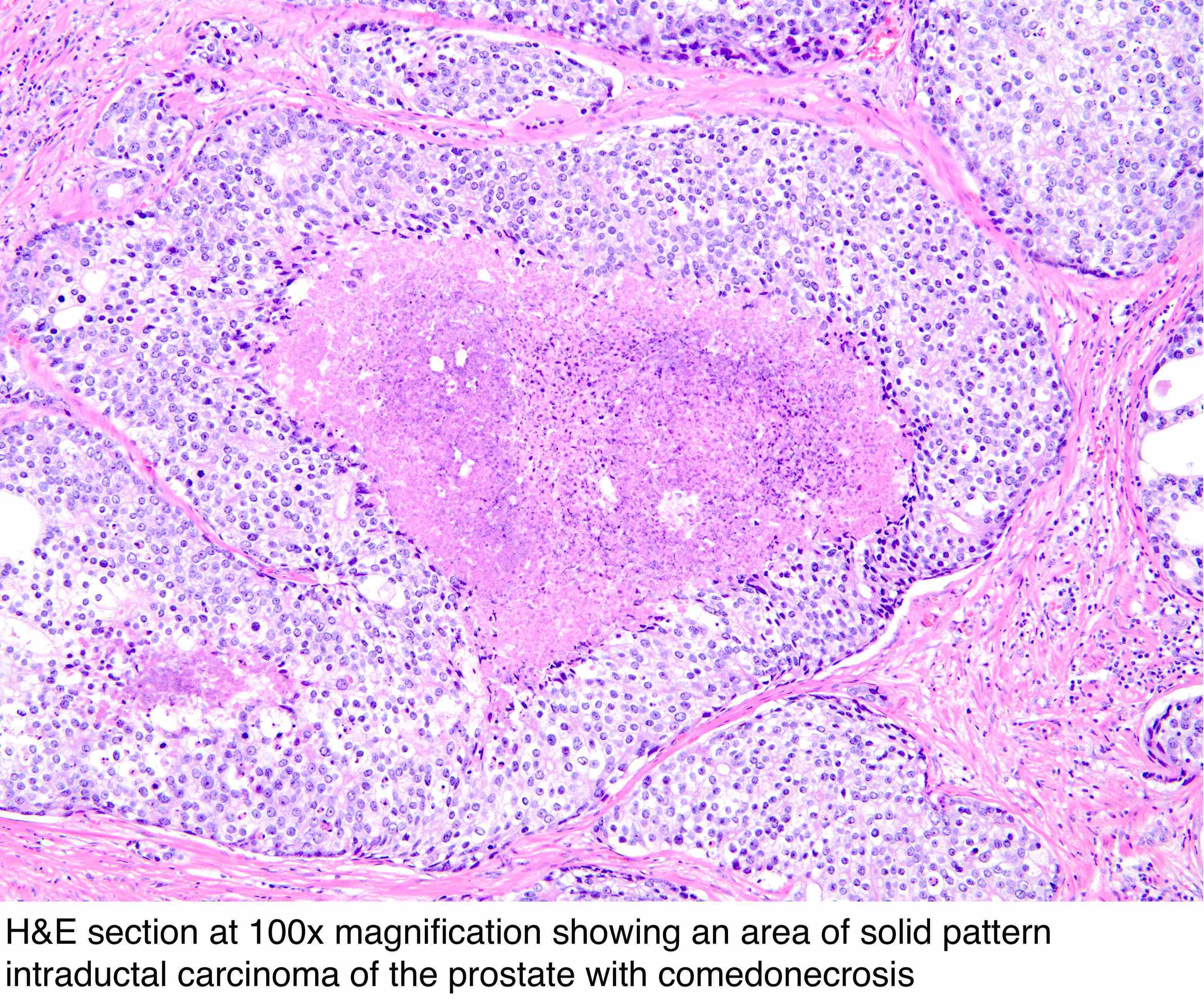 ductal adenocarcinoma prostate pathology outlines