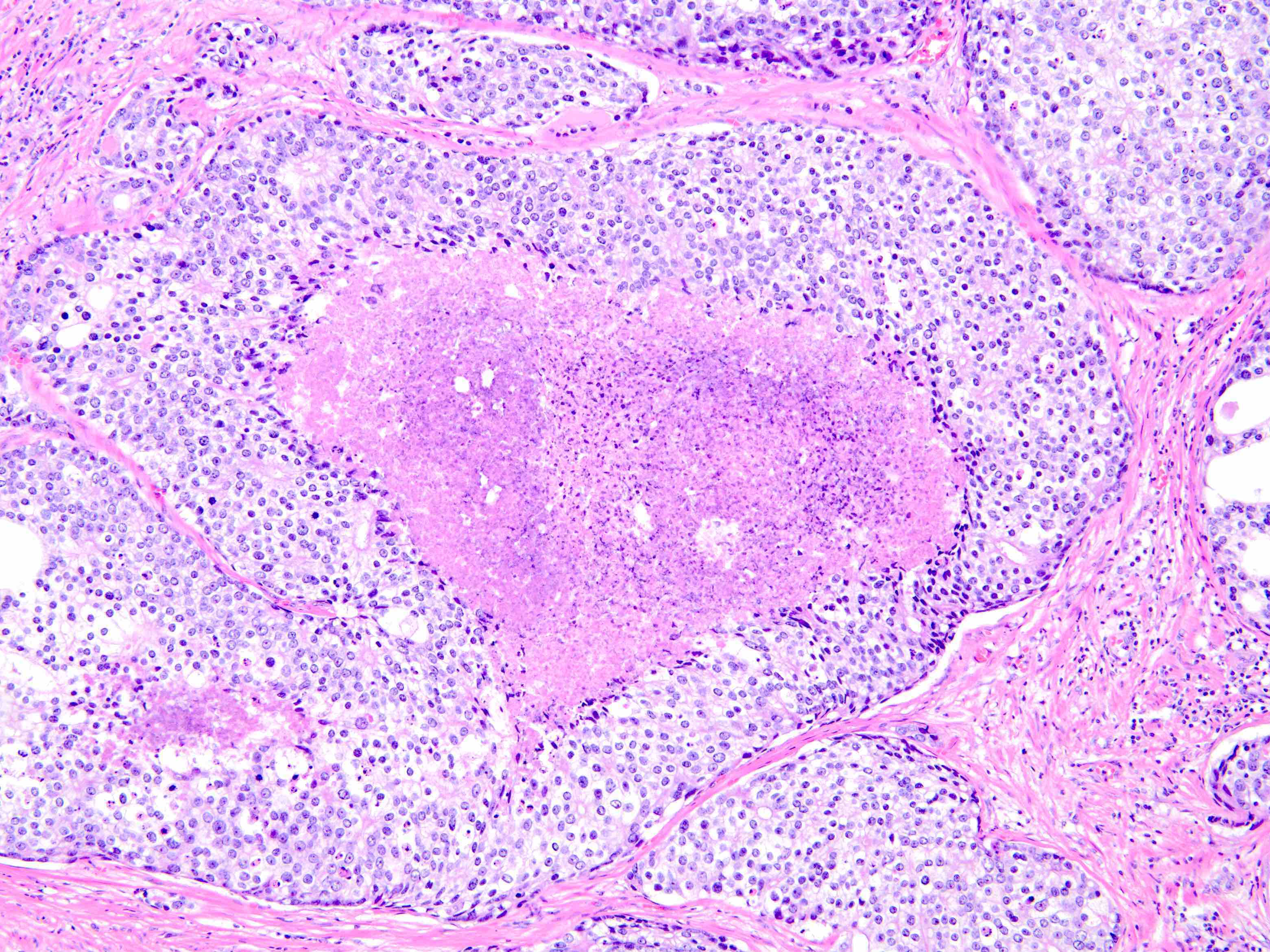 Ductal adenocarcinoma prostate histology, Képesszótár