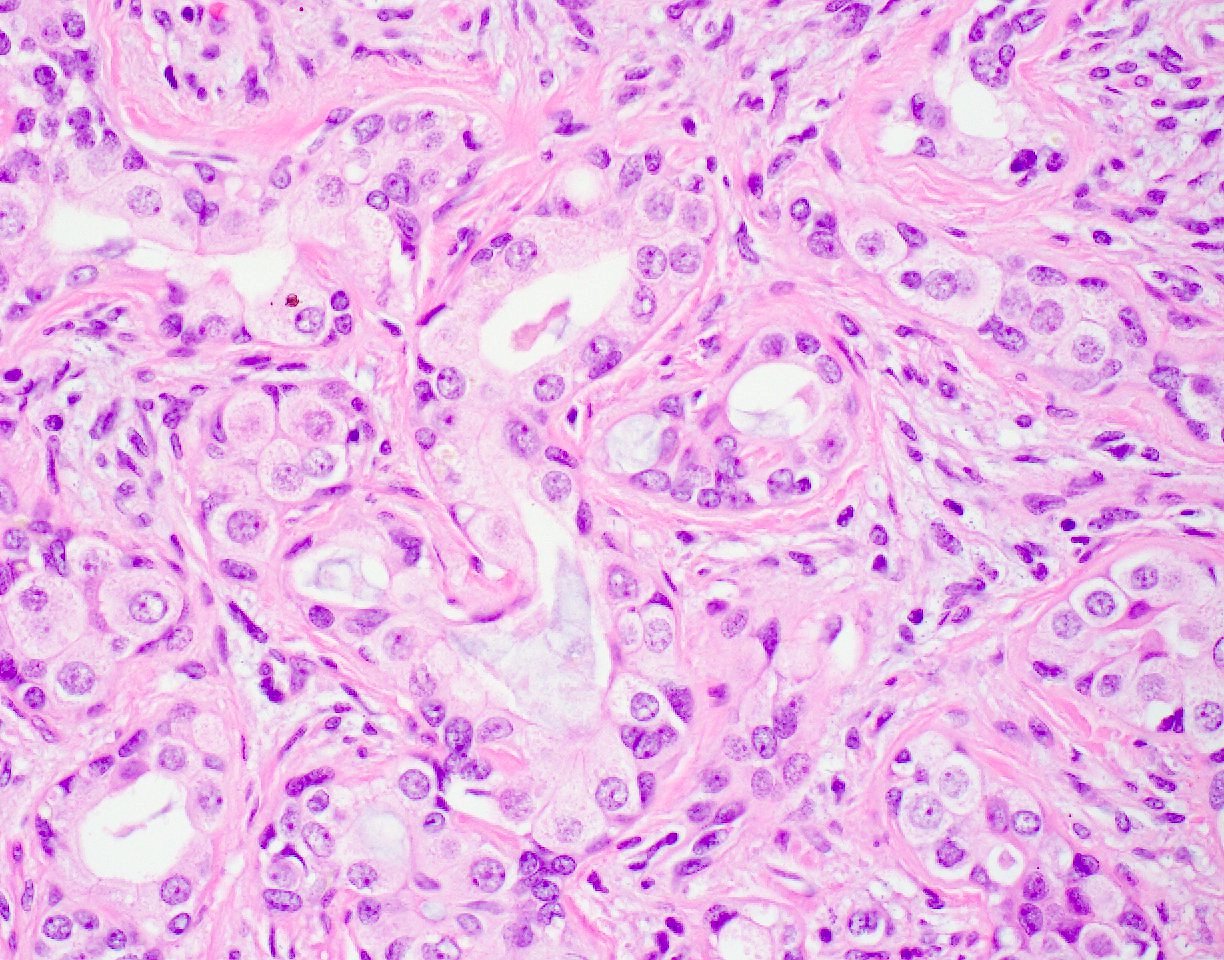 prostate adenocarcinoma pathology outlines ihc